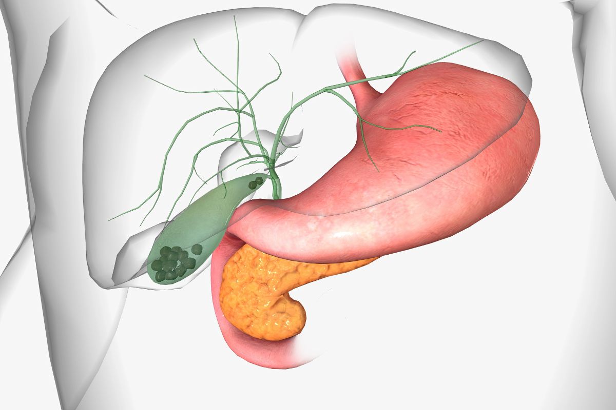 Gallstones are pieces of solid material that form in the gallbladder, a small hollow organ located beneath the liver. 3d rendering