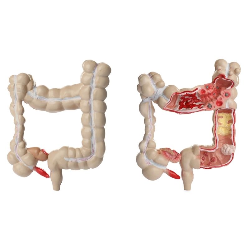 Anatomical model of large intestine on white background, collage. Gastroenterology