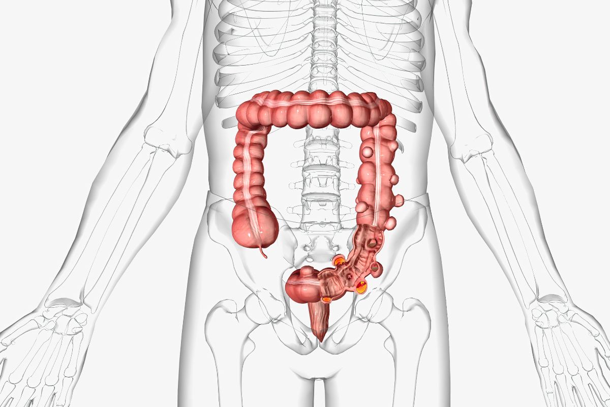 Diverticulosis occurs when small, bulging pouches develop in your digestive tract. 3d rendering