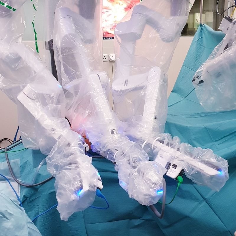 Close-up of the robotic surgical system in the operating room during robotic reconstruction for diastasis recti.