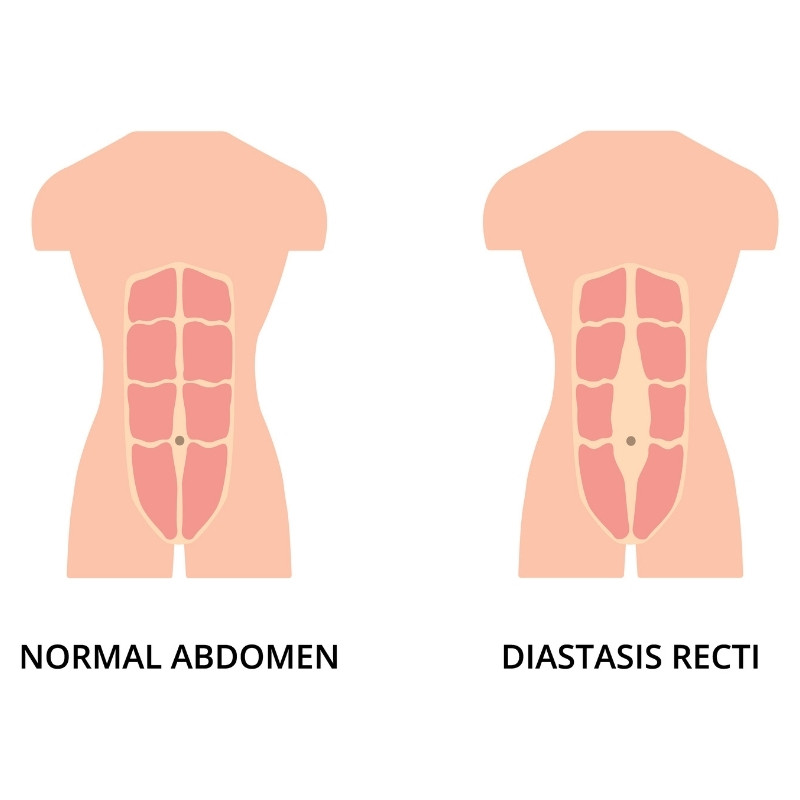 Normal toned abdomen muscles of man and diastasis recti, also known as abdominal separation. male body, health, sport